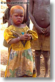 africa, burkina faso, deficiency, people, vertical, vitamin, photograph