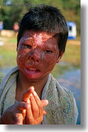images/Asia/Cambodia/People/Boys/begging-boy-w-burned-face.jpg