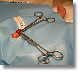 circumcision, horizontal, photograph