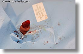 images/Topics/Circumcision/circumcision-16.jpg