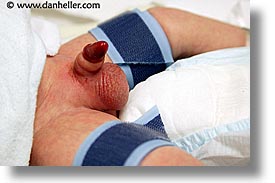 images/Topics/Circumcision/circumcision-17.jpg