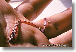 dupuytrens, hands, horizontal, personal, self-portrait, stitches, surgery, photograph